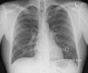 x-ray image of lungs